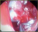 Спонтанная назальная ликворея с локализацией дефекта  основания черепа из клиновидной пазухи