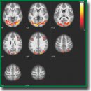 Basic Cognitive Architecture, Systemic Inflammation, and Immune Dysfunction in Schizophrenia