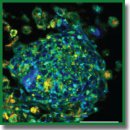 Development of a 3D Tumor Spheroid Model from the Patient’s Glioblastoma Cells and Its Study by Metabolic Fluorescence Lifetime Imaging