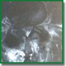Лечение пациентов с дегенеративными заболеваниями пояснично-крестцового отдела позвоночника c использованием новой методики фасеточной стабилизации имплантатом Facet Wedge
