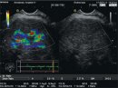 Компрессионная эластография при эндосонографии  как метод ранней дифференциальной диагностики стадий фиброзного процесса печени