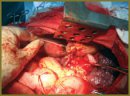 Роль расширенно-комбинированных операций в лечении  рака желудка