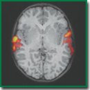The Role of Functional MRI in Understanding the Origin of Speech Delay in Autism Spectrum Disorders