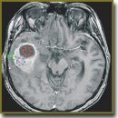Ex vivo визуализация глиальных опухолей головного мозга человека с помощью кросс-поляризационной оптической когерентной томографии: первые результаты