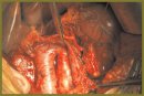 Расширенные гастропанкреатодуоденальные резекции при лечении протоковой карциномы головки поджелудочной железы