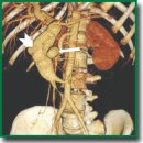 Endovascular Occlusion of Giant Posttraumatic Pseudo-Aneurysm of Superior Mesenteric Artery Connected to Mesenteric Arteriovenous Fistula