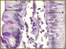 Критерии оценки морфологических изменений слизистой оболочки двенадцатиперстной кишки при гастродуодените  в катамнестическом наблюдении