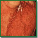 МСКТ-коронарография в диагностике хронических окклюзий коронарных артерий