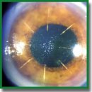 Инновационные технологии в хирургии роговицы глаза в эксперименте <i>ex vivo</i>