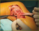 Костно-хрящевая аутопластика обширного посттравматического дефекта проксимального отдела большеберцовой кости