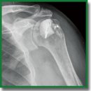 Использование аддитивных технологий в оперативном лечении застарелых задних вывихов плеча