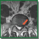Диффузионно-взвешенная магнитно-резонансная томография в диагностике компрессии корешков спинного мозга при грыжах поясничных межпозвонковых дисков