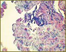 Метастазы рака мочевого пузыря в кавернозные тела полового члена 