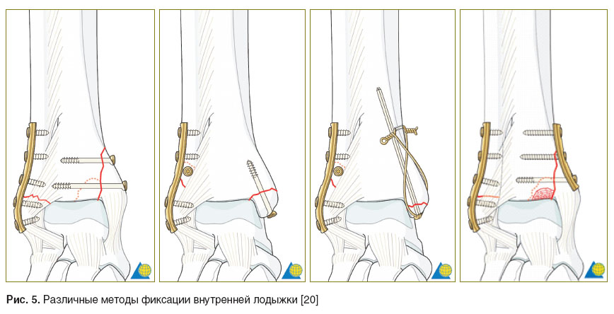 Диета После Перелома Лодыжки