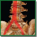 Treatment Tactics for Patients with Isolated Injuries of the Fifth Lumbar Vertebra