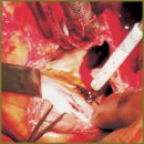 Surgical Management of Infective Endocarditis in Patients with Non-Valvular Congenital Heart Diseases