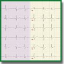 Cyberheart-Diagnostics Software Package for Automated Electrocardiogram Analysis Based on Machine Learning Techniques