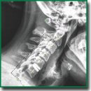 Sagittal Balance Parameters after Anterior Cervical Discectomy with Spondylodesis and Arthroplasty Using Endocarbon Endoprosthesis: Results of Randomized Study