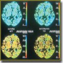 Assessment of Chronic Subdural Hematoma Perifocal Zone Microvasculature According to Perfusion Computerized Tomography Data