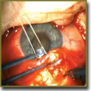 Application of Originally Designed Polymer Micro-Shunt in Open-Angle Glaucoma Surgery	