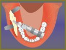 Correction of Skeletal Anomalies of Maxillofacial Area