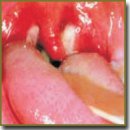 ​Lymphogranulomatosis Progress in Patient with EBV Infectious Mononucleosis