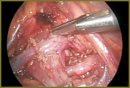 The Use of Original Technology of Moving a “Conflicting” (Accessory) Vessel in Children in Surgical Treatment of Hydronephrosis Using Laparoscopic Approach
