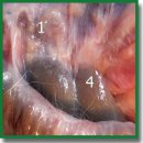 Visceral Adhesions after Tension-Free Abdominal Wall Repair with Ultra-Lightweight Synthetic and Titanium-Containing Meshes