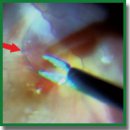 A New Method of Video Recording the Posterior Fundus Segment