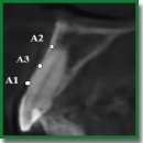 Preservation of Bone and Soft Tissue Components of the Alveolar Ridge during Immediate Implantation in the Aesthetic Zone of Jaws with Bone Deficiency