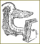 External Transintestinal Wirsungostomy is a Procedure of Pancreatojejunal Anastomosis Incompetence Prevention