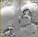 The Management of Cystoarterial Fistula of Pancreas