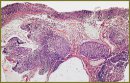Optimization of the Neck of the Uterus Neoplasia Diagnosis Using Optical Coherent Tomography