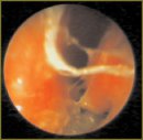Video Endoscopic Method of Estimation State of Nasal and Pharyngonasal Cavity in Children with Bronchial Asthma