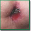 The Use of Transvenous Lead Extraction of Non-Infected Leads to Prevent Long-Term Lead-Related Complications