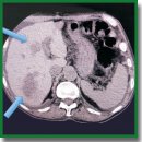 Isolated Hyperthermic Hepatic Chemoperfusion in Patients with Colorectal Cancer and Isolated Non-Resectable Liver Metastases