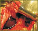 Operative Treatment of a Choledoch Cyst and Correction  of Attendant Pathology in Children