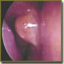 Capabilities of Nasal Videoendoscopy in Diagnostics of Pharyngeal Tonsil Condition in Children with Bronchial Asthma