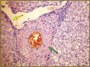 Pathologic Criteria to Estimate the State of the Liver in Potential Multi-organ Donors with Brain Death