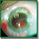 New Technologies in Intraocular Correction of Aphakia: Assessment of the Long-Term Results
