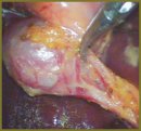 New Insights in the Prevention of Complications in Laparoscopic Cholecystectomy