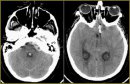 Management of De Novo Aneurysms of Supra-, Infratentorial Locations