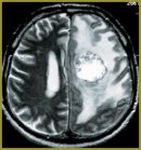 Proton Magnetic Resonance Spectroscopy in Differential Diagnosis of Brain Tumors