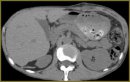 Diagnostic and Treatment Algorithms in Case of a “Difficult” Diagnosis in Patients with Pancreatic Pseudocysts