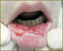 A Case of Successful Treatment of Erythema Multiforme (Stevens–Johnson Syndrome)