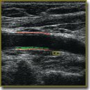 Echotrecking Is a Novel Technology to Assess Structural and Functional Properties of Carotid Arteries (Review)