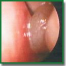 Periostin as a Biomarker of Allergic Inflammation in Atopic Bronchial Asthma and Allergic Rhinitis (a Pilot Study)