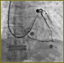 The Efficacy of Retrograde Myocardial Perfusion  in Endovascular Correction of Severe Anterior Coronary  Circulation Disorders in Patients with Non-ST-Elevation Acute Coronary Syndrome