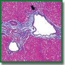 Cellular and Molecular Mechanisms of Toxic Liver Fibrosis in Rats Depending on the Stages of Its Development