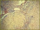 A Case of Primary Biliary Cirrhosis